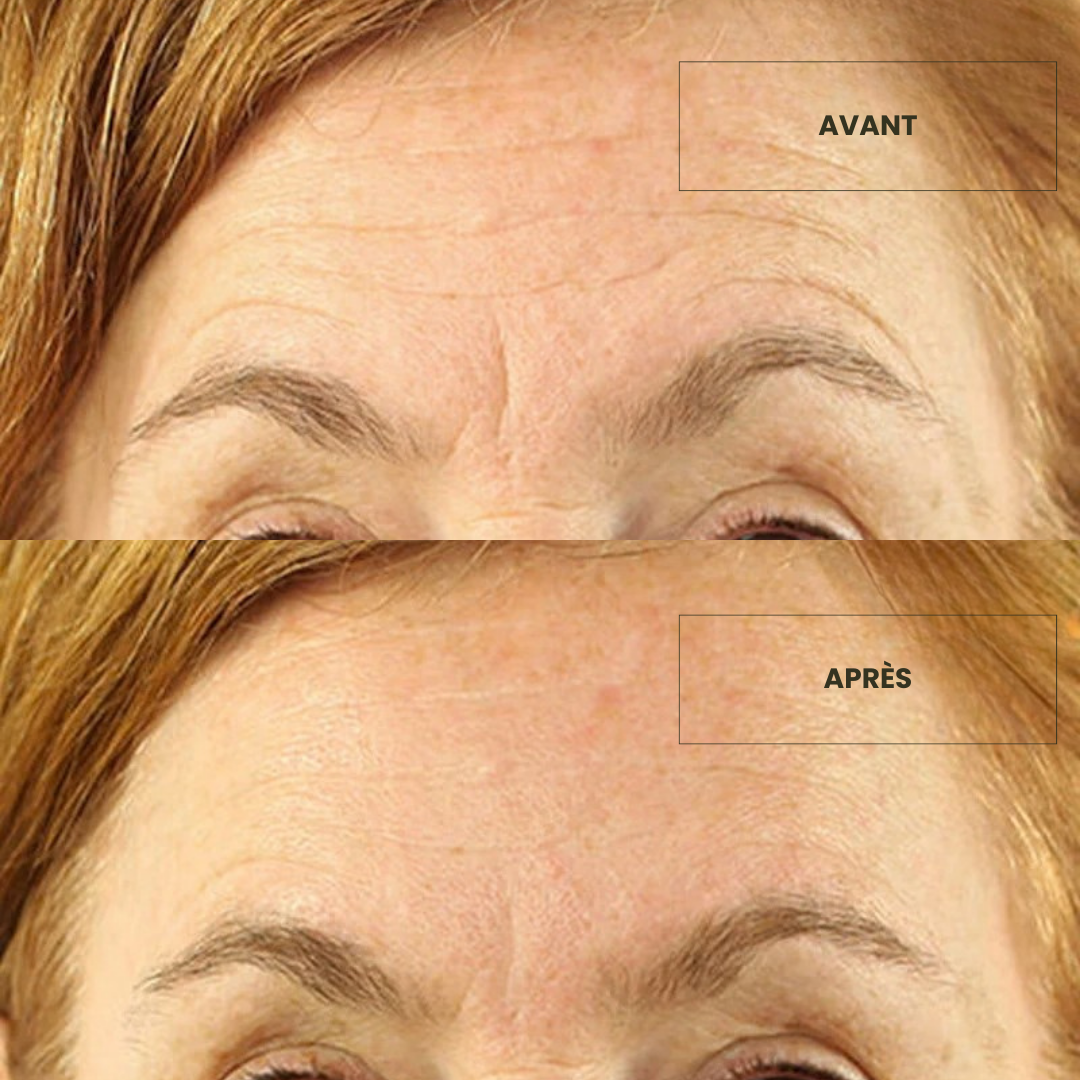 Patch Frontal Anti-ride